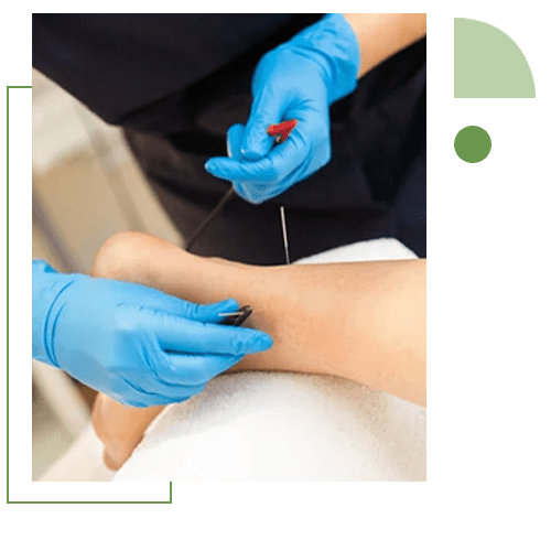 Dry-Needling-Benefits