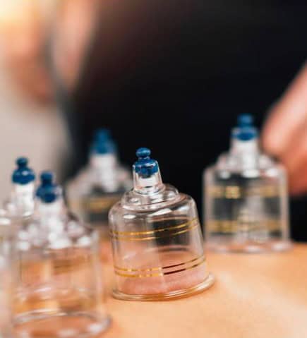 Cupping Cupping